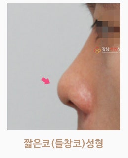 짧은코성형(들창코성형)