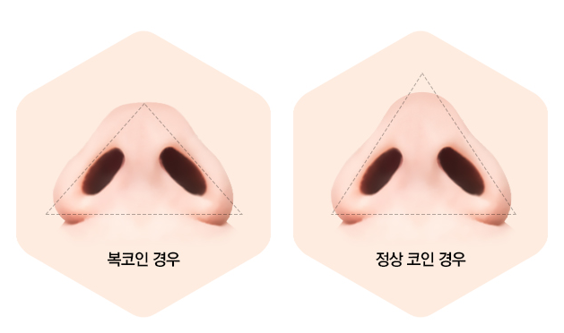 복코성형