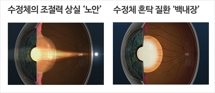 노안 vs 백내장, 증상 및 치료법은?