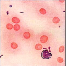 재생불량성 빈혈 Aplastic anemia