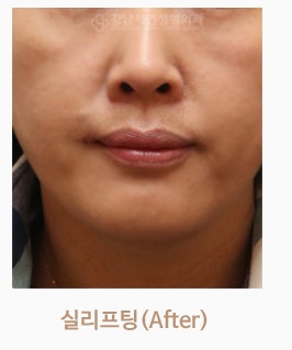 실리프팅