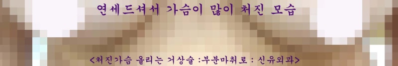 가슴보형물제거하면서 동시에 처진가슴 올리는 거상술 같이 받으신 분 : 4.5cm.