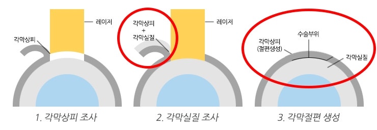 라식 라섹수술과정에 따른 특징(+스마일)