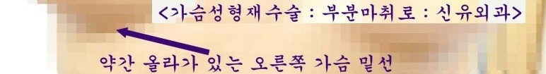 밑선비대칭을 부분마취 유륜절개하여 교정한 가슴성형재수술