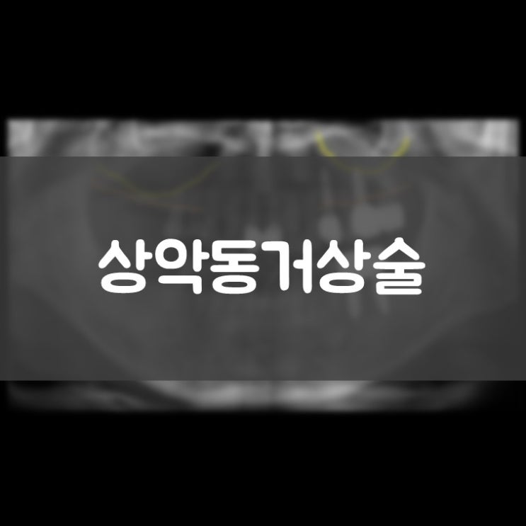 수원삼성전자치과 영통임플란트 상악동거상술이 뭔가요? 상악동 거상술 뼈이식 임플란트