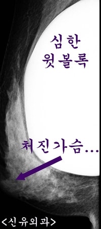 임신출산수유후 처진가슴 올리는 거상술과 작은 보형물로 교체 동시에 하신 분