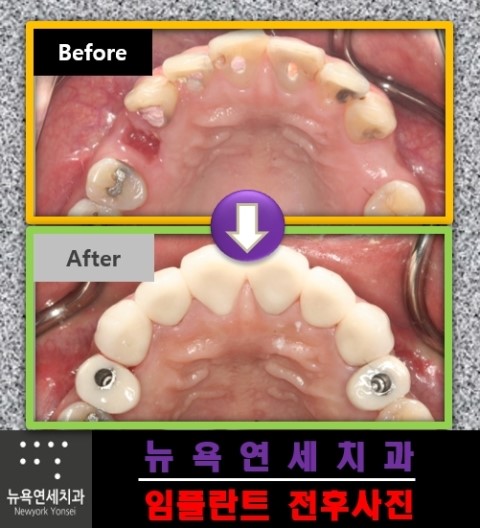  임플란트 수술 통증과 출혈이 적은 무판막 임플란트 시술