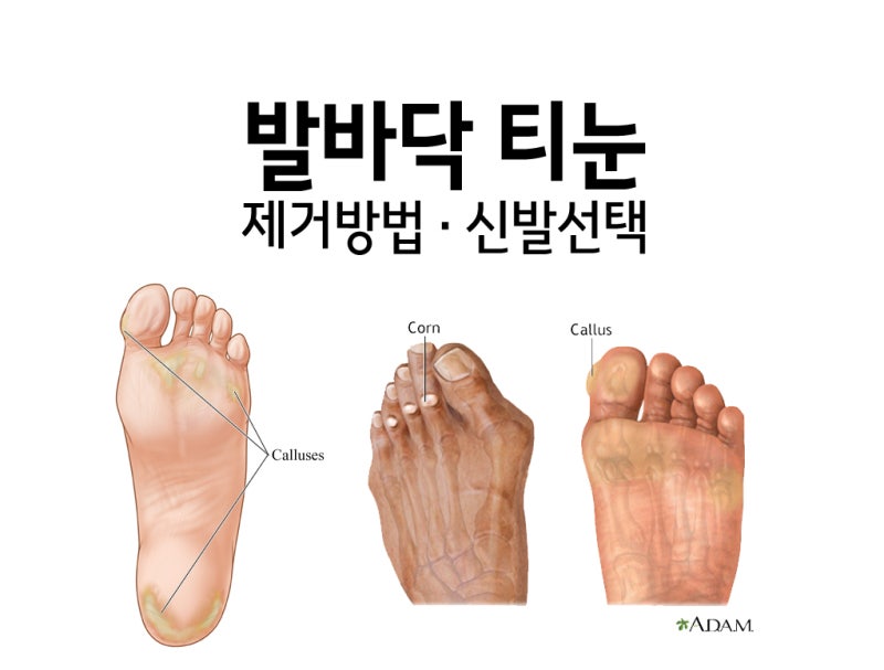 발바닥 티눈 제거 및 원인