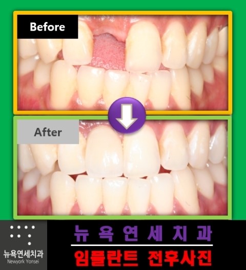  앞니가 없는 경우 심미 임플란트 시술로 자연치아를 대체 할 수 있습니다.