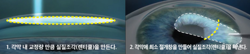 스마일라식을 선호하는 이유!