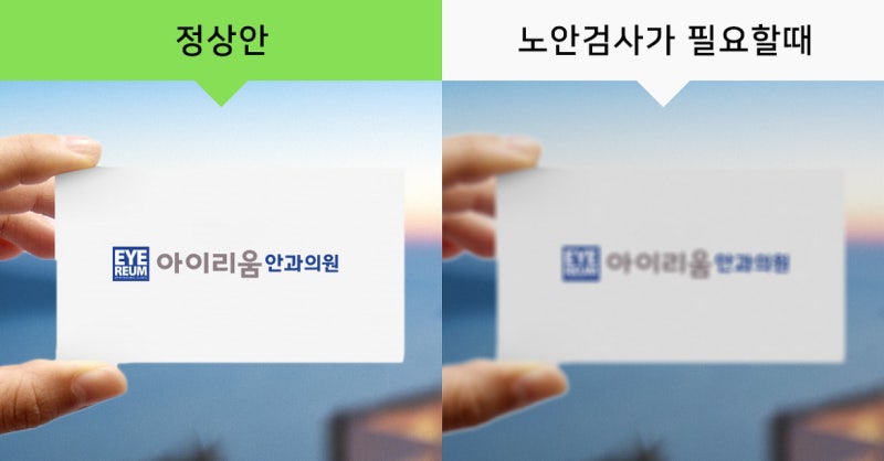 [아이리움] 백내장 초기증상은? 백내장 치료 FAQ