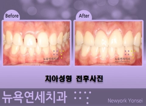  라미네이트로 티안나게 앞니 성형을 할 수 있습니다.