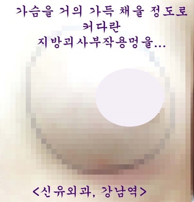 11cm크기의 가슴지방이식부작용석회화지방괴사된 멍울을 제거하고 빨대(배액관) 꽂았던 분