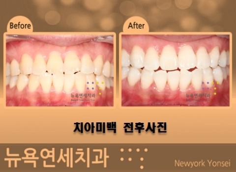  치아미백 기간이나 횟수는 어느 정도가 적합할까요?