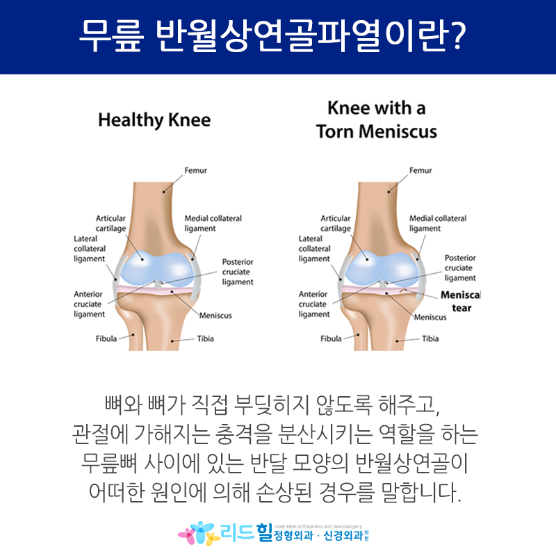 반월상 연골 손상? 무릎 아프신 분 <필독>
