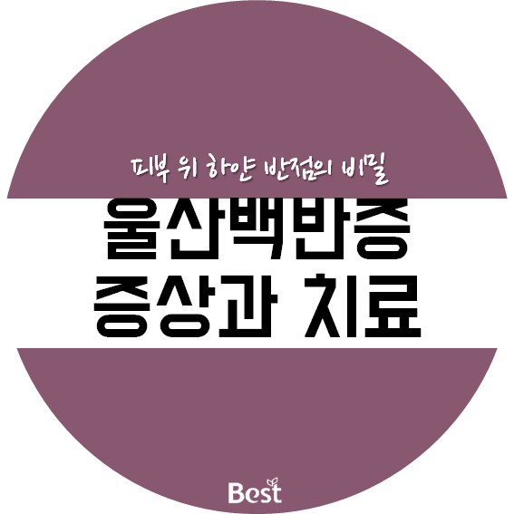 울산백반증치료 원인부터 정확히