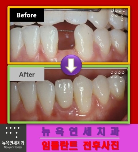  임플란트 시술이 진행 된 전후 사례들을 정리하여 보겠습니다.