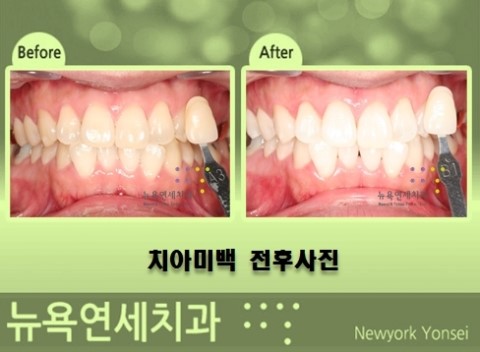  강남역에 위치한 뉴욕연세치과의 치아미백 프로그램 소개