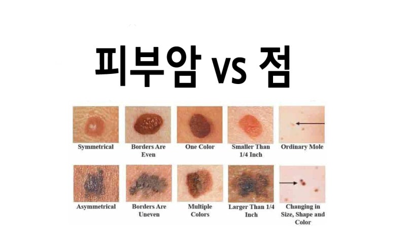 피부암 초기증상 - 점과 구별 (사진으로 알아보자) : 네이버 블로그 피부암 초기증상 - 점과 구별 (사진으로 알아보자) : 네이버 블로그