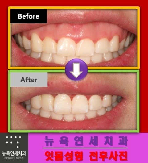  치과에서 돌출되고 노출이 많은 잇몸을 잇몸성형하는 방법