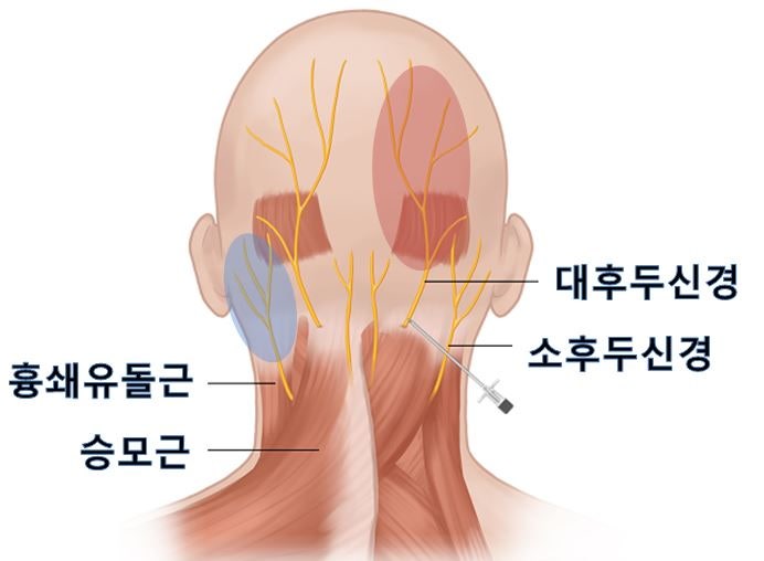 후두통증/후두통증/후두신경통/경추1번/청량리통증의학과/신경과 3