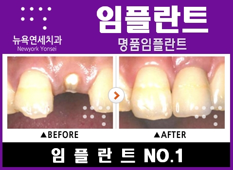  @@@임플란트방법,임플란트시술,임플란트시술방법###