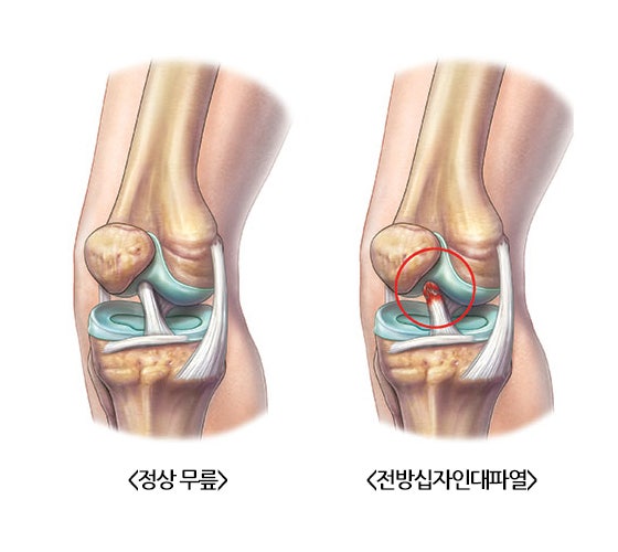 무릎 전방십자인대 파열 수술은 언제 하면 되나요? 8