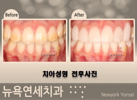  라미네이트치아성형,치아성형,올세라믹치아성형,앞니치아성형