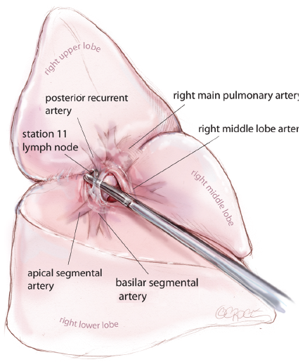 VATs Lobectomy RLL / 흉강경 폐엽 절제술 수술 과정 (pf.성) : 네이버 블로그