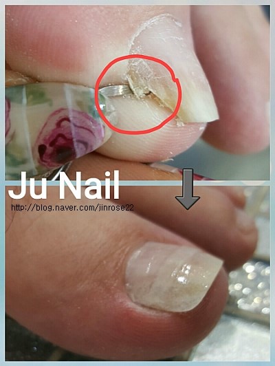 원인은 잘못깍은발톱/분당용인보정동수지죽전네일/주네일 원인은 잘못깍은발톱/분당용인보정동수지죽전네일/주네일