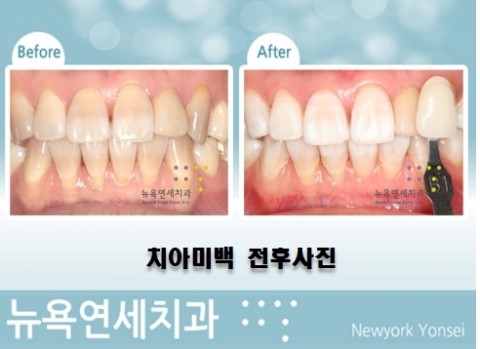 치아미백치료비용,치아미백비용,치아미백프로그램,치아미백종류