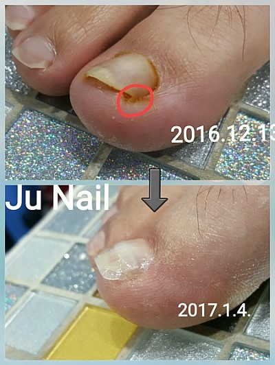 내향성발톱병원수술재발/분당용인보정동수지죽전네일/주네일 내향성발톱병원수술재발/분당용인보정동수지죽전네일/주네일
