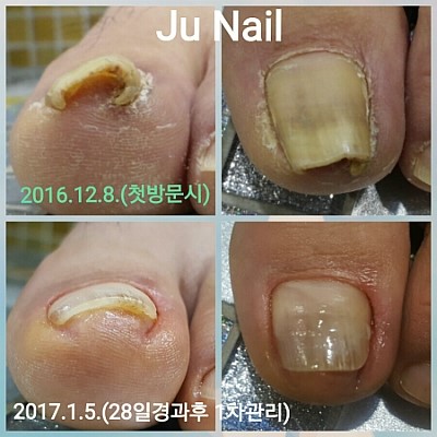 고통스런 파고드는발톱/분당용인보정동수지죽전네일/주네일 고통스런 파고드는발톱/분당용인보정동수지죽전네일/주네일
