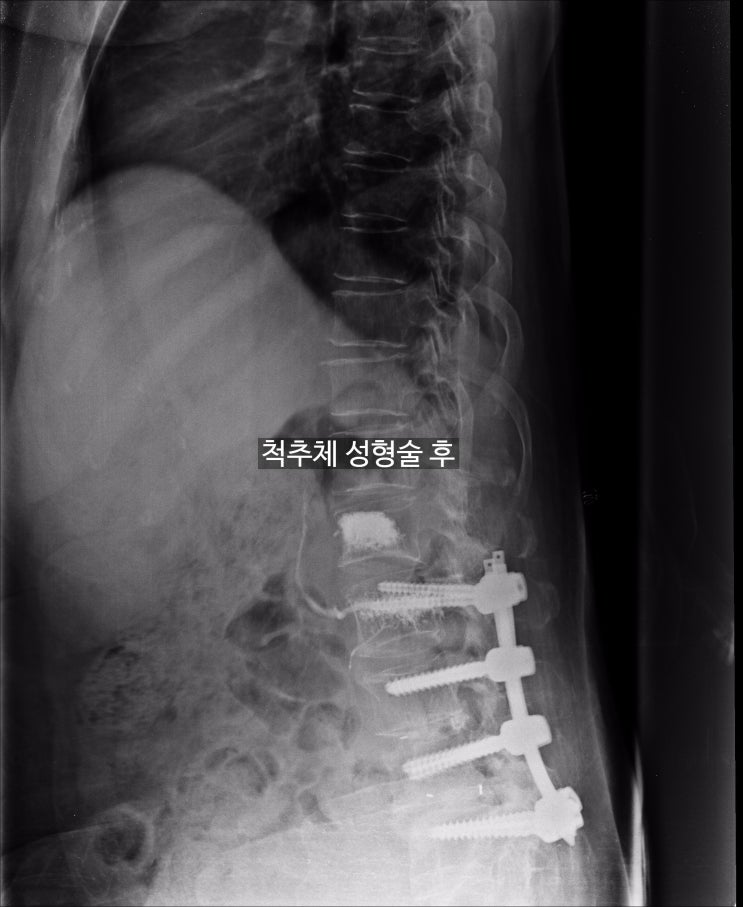 요추 3번(L3)압박골절에 따른 장해청구 사례