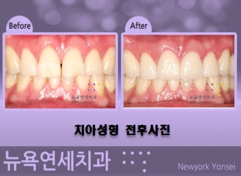  #앞니성형라미네이트,앞니성형,앞니성형전문치과,앞니성형추천#
