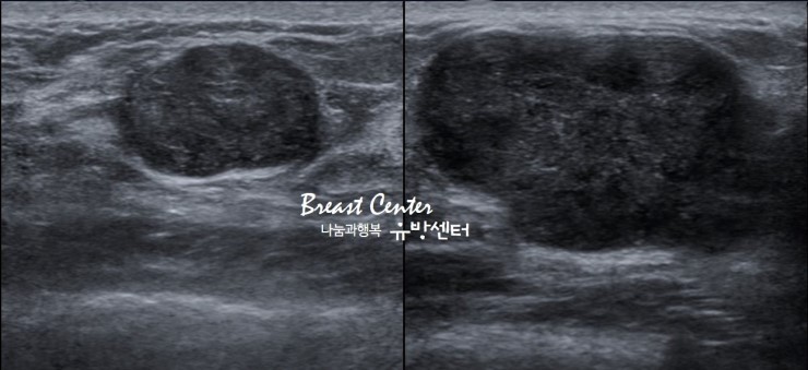 유방의 섬유선종을 나타낼 수 있는 증상 11