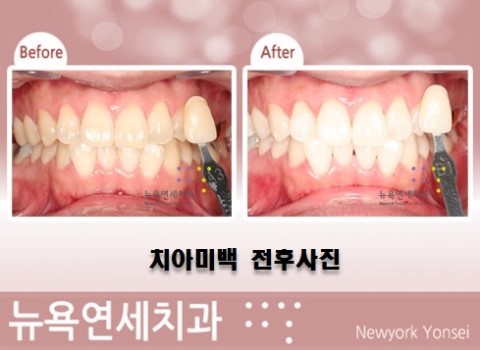 치아미백치료방법,치아미백방법,치아미백추천,치아미백병원추천