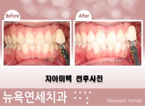  치아미백치료방법,치아미백방법,치아미백추천,치아미백병원추천