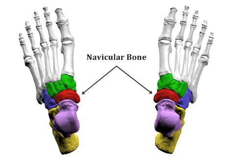 부주상골 증후군(accessory navicular bone syndrome) : 네이버 블로그
