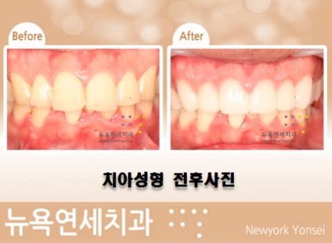  #치아성형술,치아성형시술,치아성형수술,앞니치아성형#