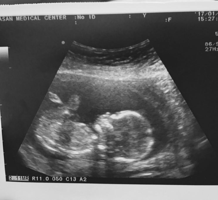  15주 5일(16주 2차기형아검사 통과)