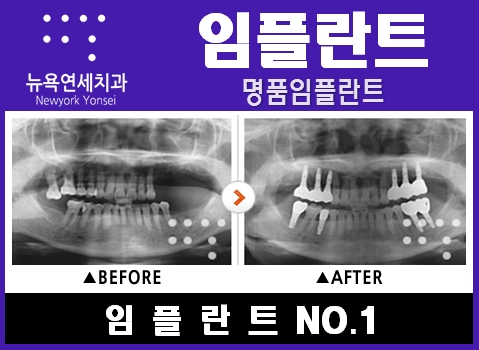  #임플란트과정,임플란트치료방법,임플란트치료,임플란트치료비#