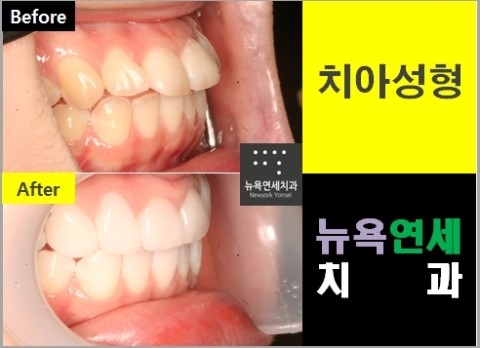  #앞니교정치과,앞니교정,앞니교정병원,앞니치아성형교정#