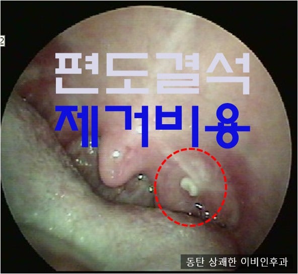 편도결석제거방법 제거원인 증상비용