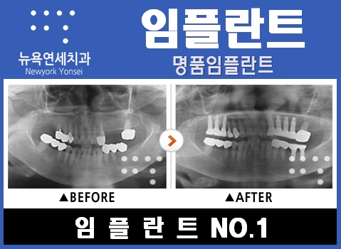  #임플란트잘하는곳,임플란트추천,임플란트유명한치과,임플란트병원추천#