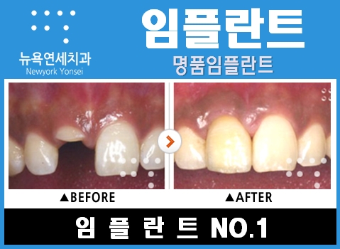  #임플란트수명,임플란트,임플란트기간,임플란트잘하는방법#