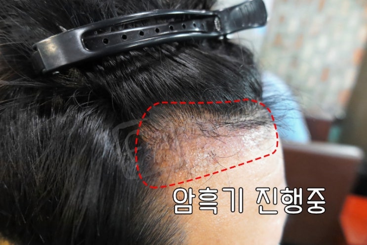  남자 앞머리 모발이식 후 암흑기 극복 퍼니M 테이프 스티커붙임머리
