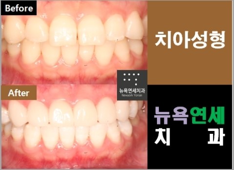  ##앞니라미네이트교정,앞니라미네이트성형,앞니라미네이트,앞니교정성형##