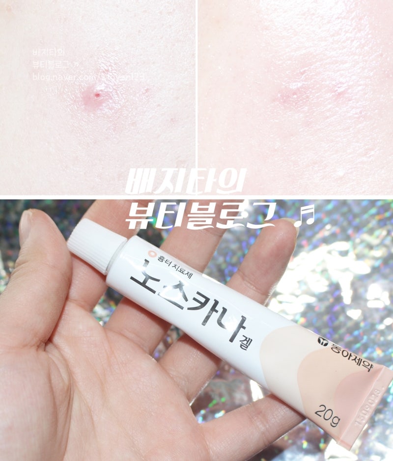 여드름흉터없애는법 노스카나겔 사용법 알려줄게 3