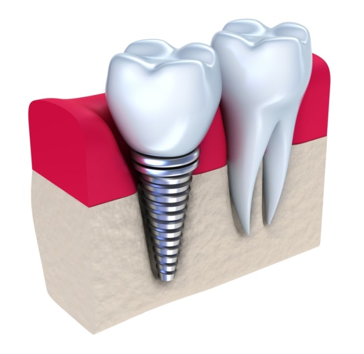 [인창동 치과/야간지료/임플란트/치아교정/사랑니발치/소아치과]부족한 잇몸뼈가 문제라면 임플란트뼈이식